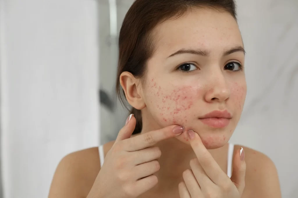 Acne Scars Types – How to Get Rid of Acne Scars Types
