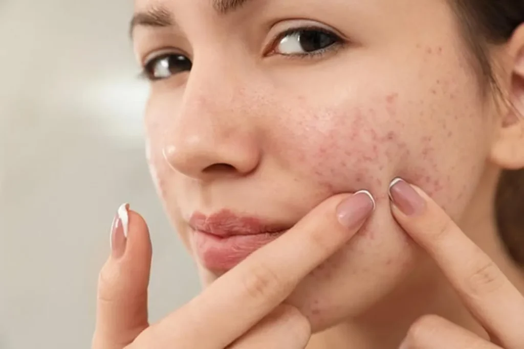 Uncovering the Differences Between Non-Inflammatory and Inflammatory Acne